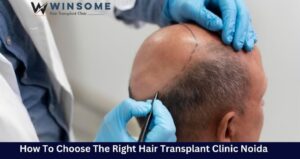 hair transplant clinic in Noida