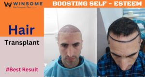 Hair Transplant Surgery