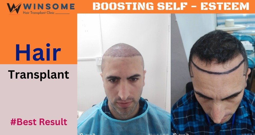 Hair Transplant Surgery