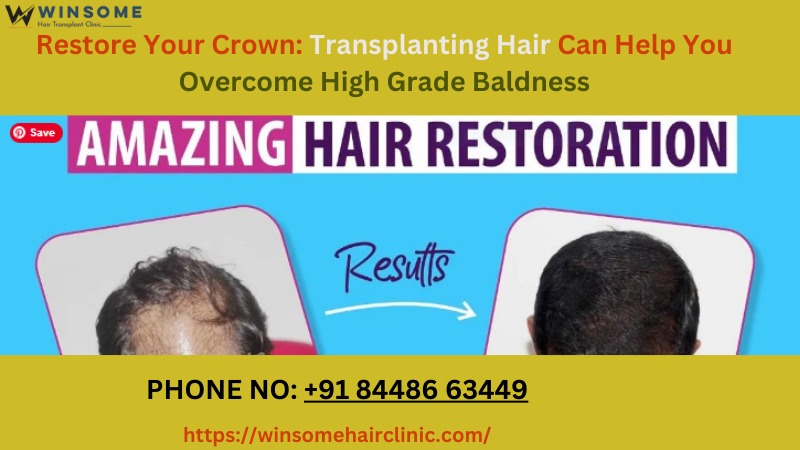 Hair transplantat in Noida