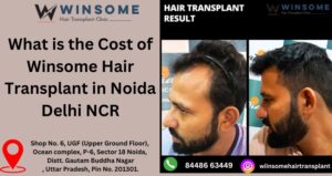 Hair Transplant in Noida Delhi NCR