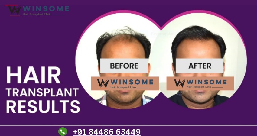 hair transplant clinic in noida