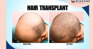hair transplant clinic in Noida