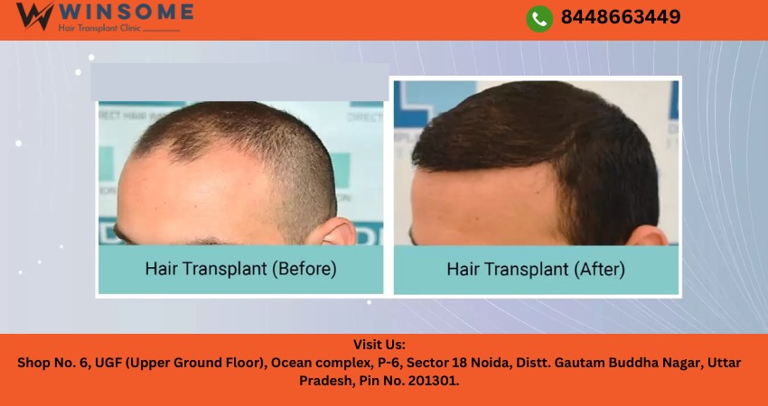 hair loss treatments
