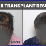 Hair Transplant
