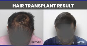 Hair Transplant