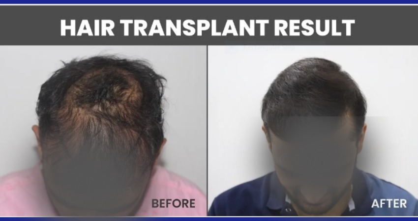 Hair Transplant